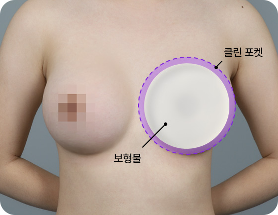 시착가능 보형물 가슴확대