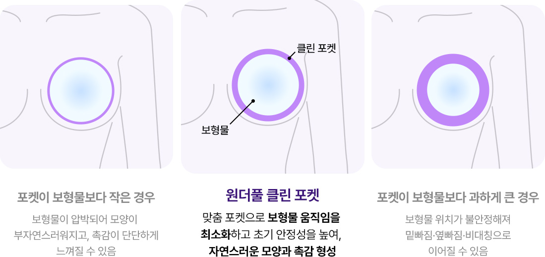 원더풀 클린 포켓 맞춤 포켓으로 보형물 움직임을 최소화하고 초기 안정성을 높여, 자연스러운 모양과 촉감 형성