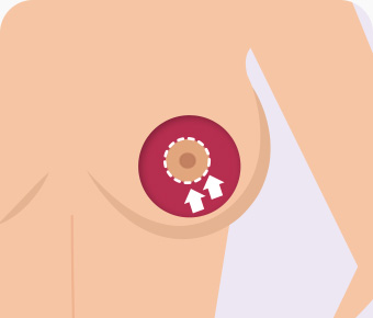 가슴축소 유륜절개 조직을 절제 유륜을 따라 봉합