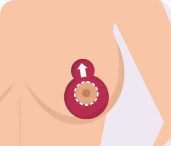 가슴축소 수직절개 유두를 당겨올려 절개부위 봉합