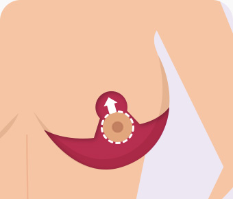 가슴축소 오자절개 유두를 당겨 올리고 절개부위 봉합