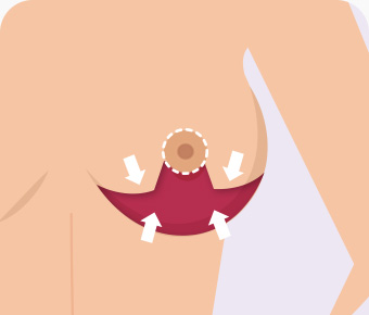 가슴축소 오자절개 처진 유선과 피부 조직 절제