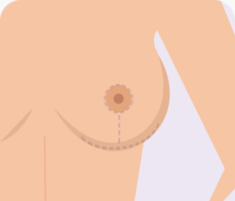 가슴축소 오자절개 봉합