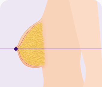가슴축소 지방흡입 유선조직 손상없이 지방만 흡입