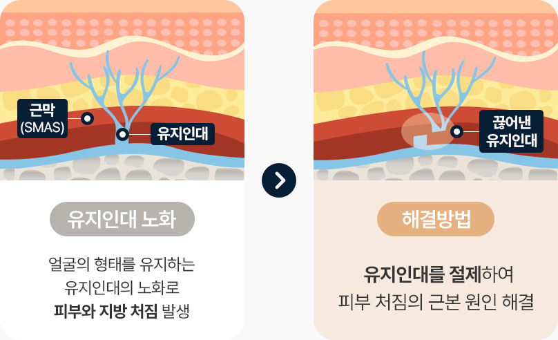 안면거상 근막 유지인대 노화 피부와 지방처짐발생 유지인대를 절제 피부처짐 원인 해결