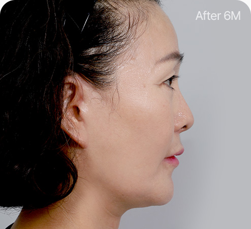 안면거상 수술방법 늘어진 피부정리 섬세하게 절개선 봉합