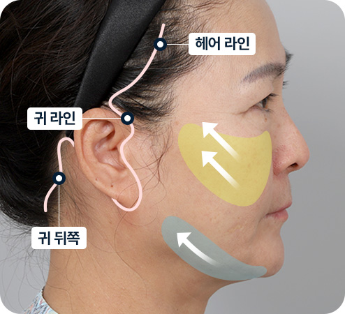 안면거상 절개범위 헤어라인 귀라인 귀뒤쪽 정교한 절개