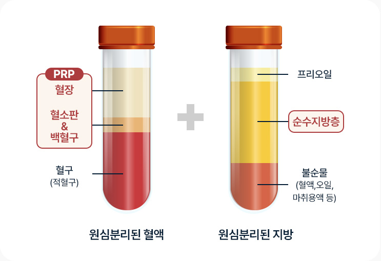 얼굴지방이식 원심분리된 혈액 PRP 혈장 혈소판+백혈구 원심분리된 지방 순수지방층