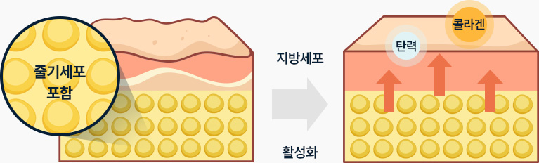 줄기세포 포함 활성화 지방세포는 탄력 콜라겐 증가