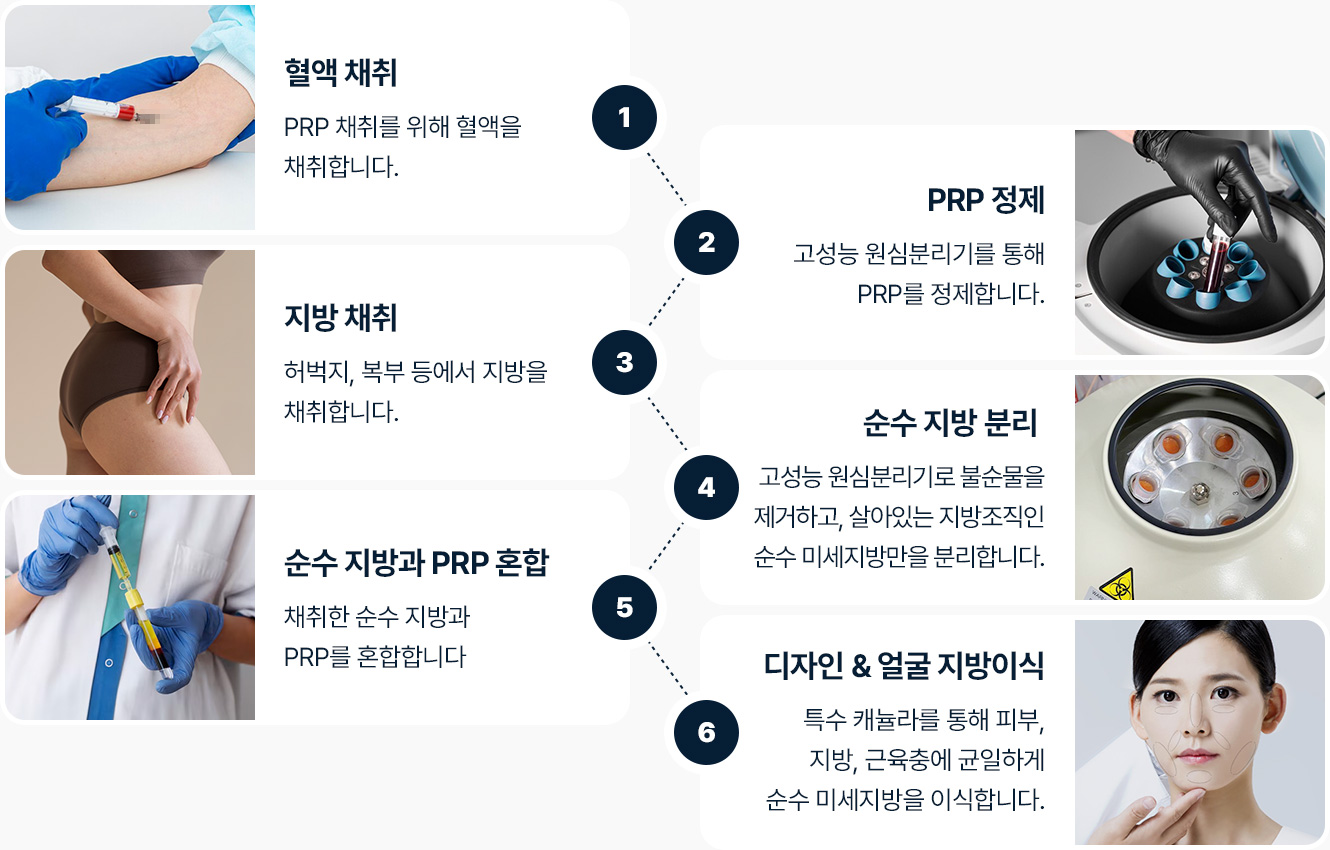 얼굴지방이식 수술과정 혈액채취 PRP정제 지방채취 순수지방분리 순수지방과 PRP 혼합 디자인 및 얼굴지방이식