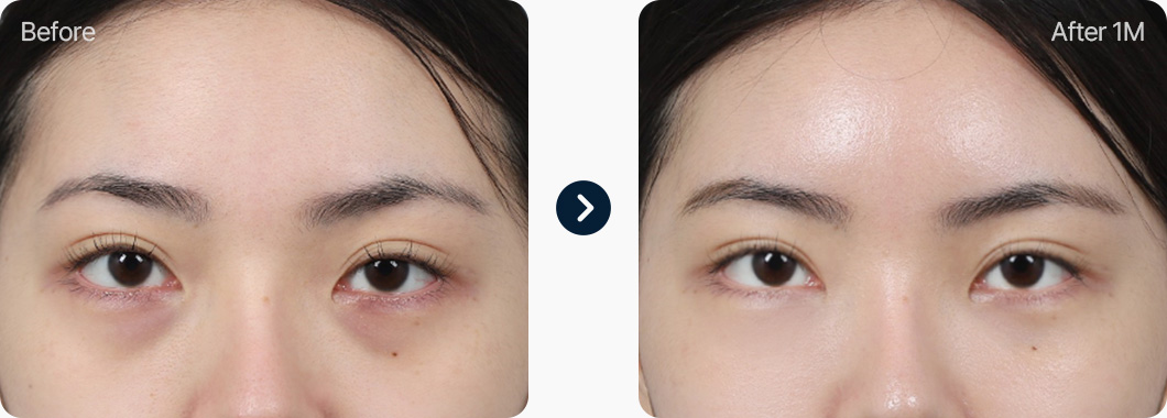 얼굴지방이식 전후사진 얼굴지방이식후기 눈밑 지방이식 전후