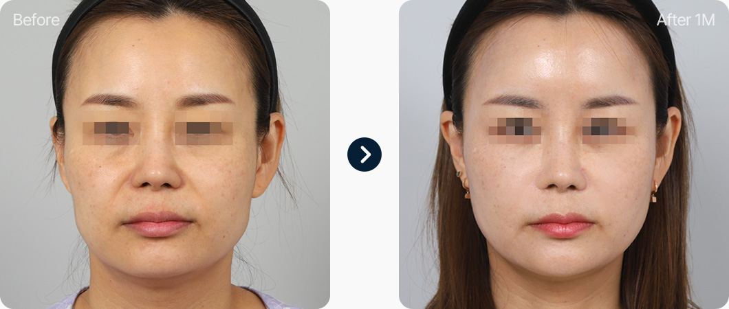 얼굴지방이식 전후사진 얼굴지방이식후기 풀페이스 지방이식 전후