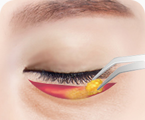 아래 눈꺼풀 밑 절개 늘어진 피부 불필요한 지방제거 재배치