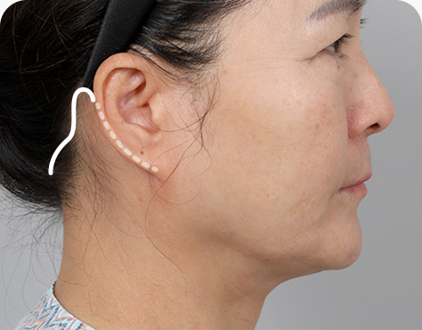 원더풀 목거상 귀 뒤에서 헤어라인 안쪽으로 절개