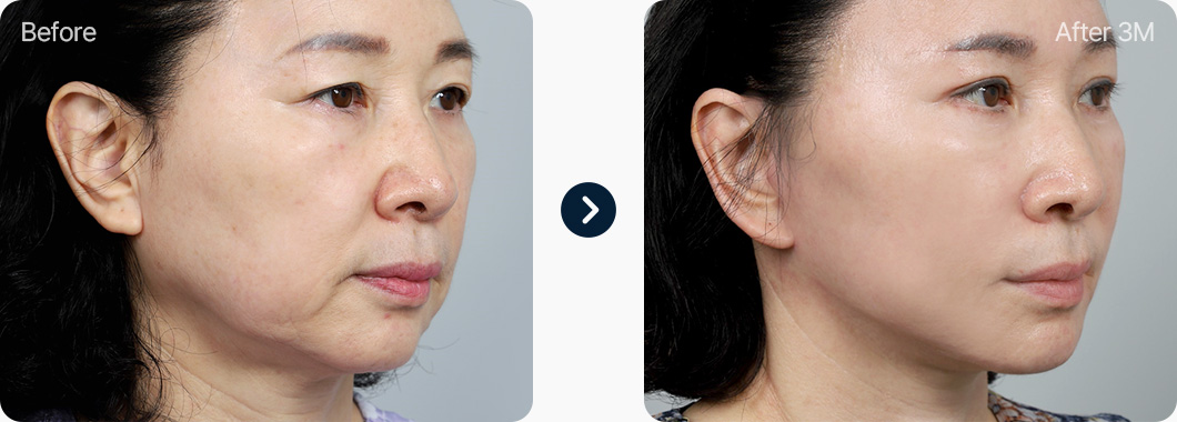 원더풀 목거상 전후사진 목거상후기