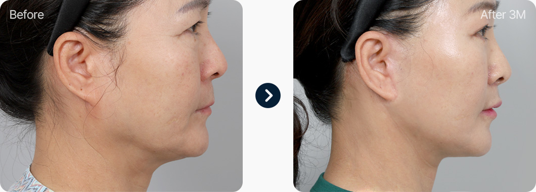 원더풀 목거상 전후사진 목거상후기