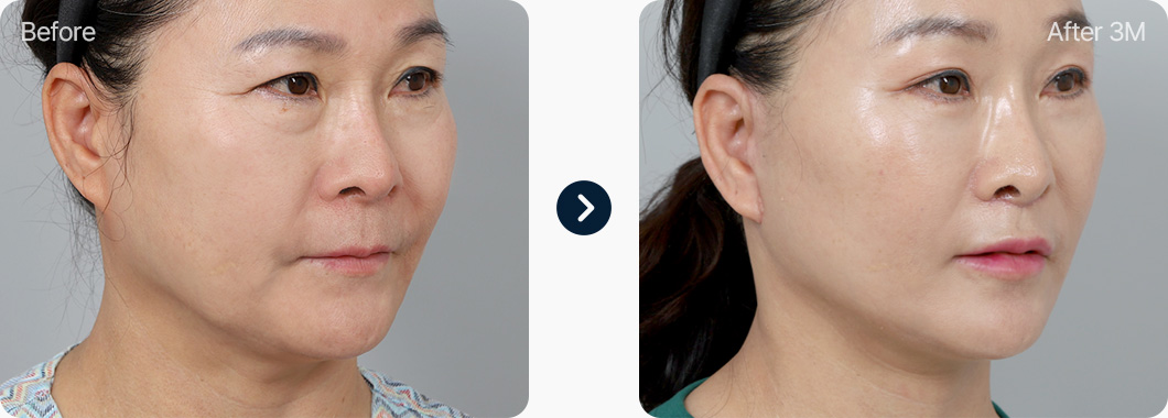 원더풀 목거상 전후사진 목거상후기