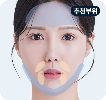 실리프팅 민트파인실 추천부위 이마 팔자주름 심부볼 이중턱