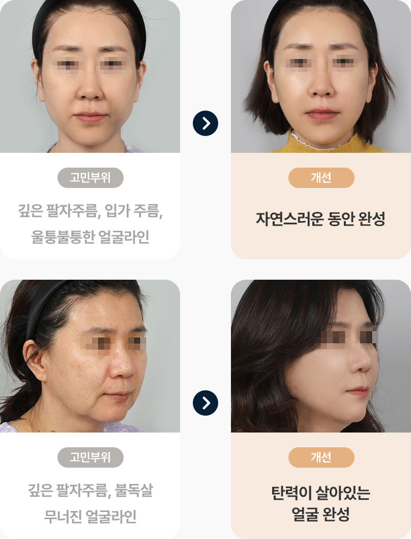 실리프팅 고민부위 팔자주름 입가주름 울퉁불퉁 얼굴라인 실리프팅으로 개선 자연스러운동안 완성 고민부위 깊은 팔자주름 불독살 무너진 얼굴라인 실리프팅으로 개선 탄력있는 얼굴완성