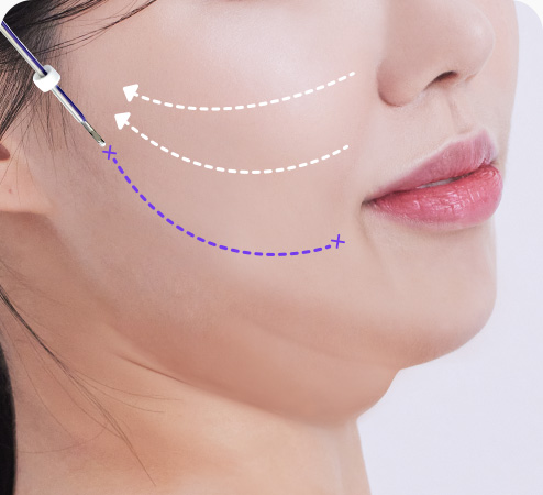 실리프팅 수술방법 캐뉼라로 실 삽입