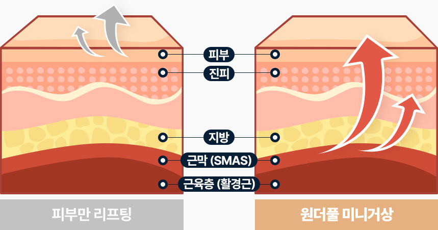 안면거상 4중리프팅 늘어진 유지인대 끊기 피부 진피 근막 근육층 4중으로 당겨 리프팅