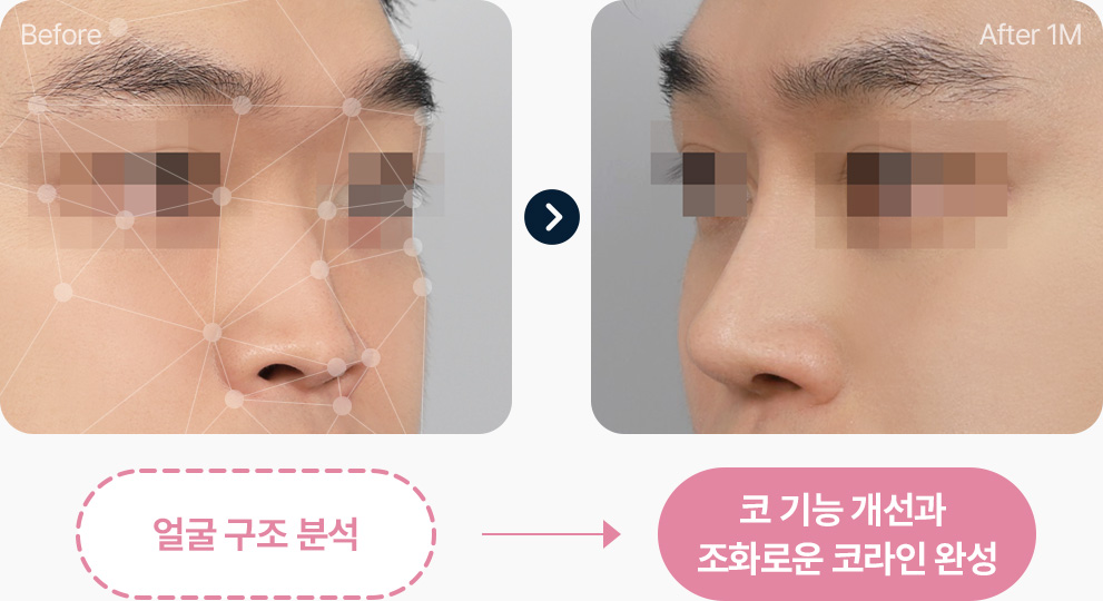 얼굴구조 분석 코 기능개선 조화로운 코라인