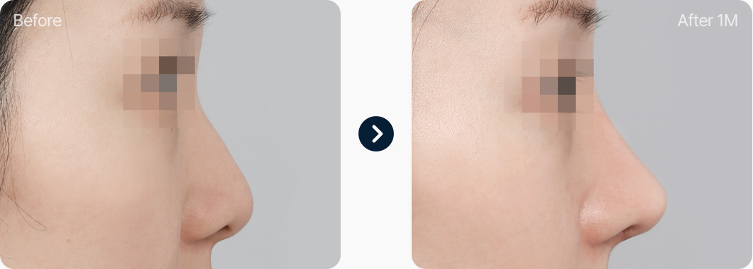 기능코성형 비중격연골+귀연골 전후사진