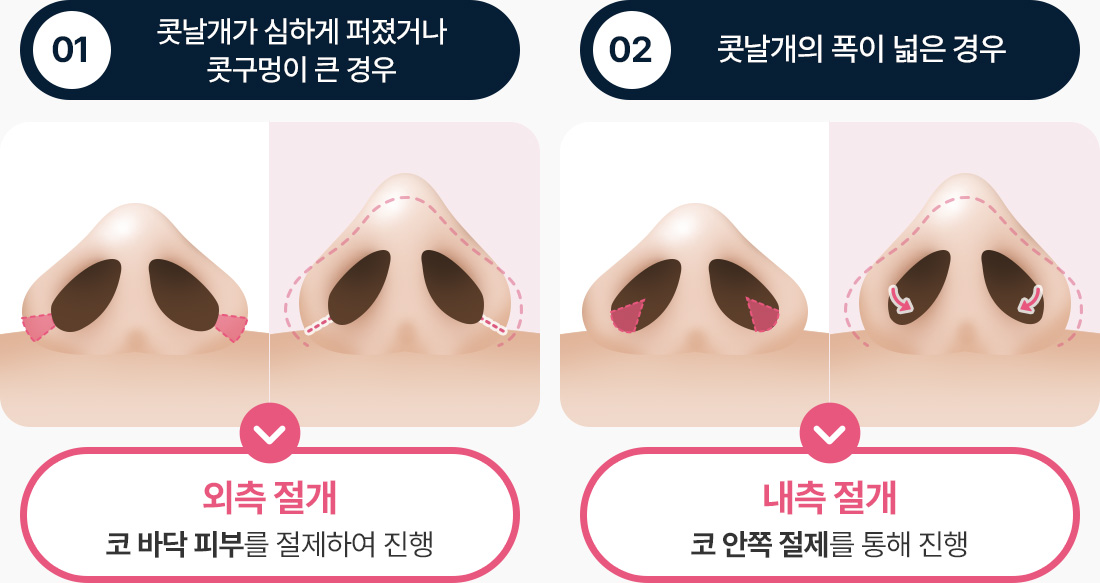 심하게 퍼진 콧날개 큰 콧구멍 외측절개 코 바닥 피부 절제 폭 넓은 콧날개 내측 절개 코 안쪽 절제