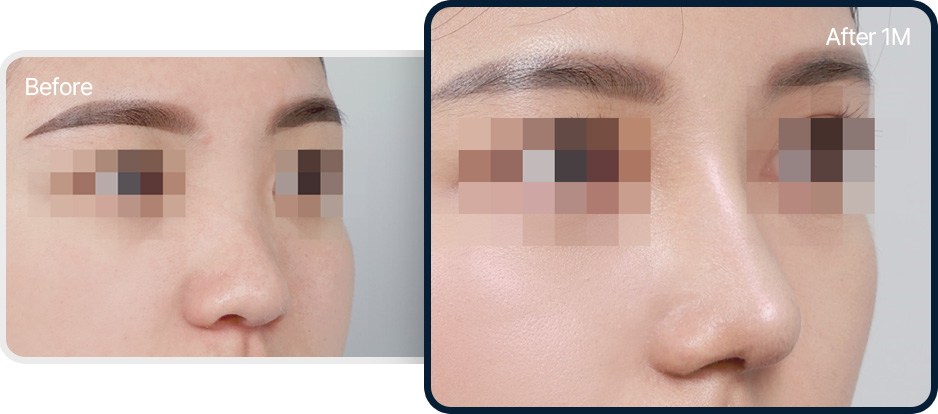 낮은코 성형 전후사진