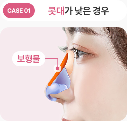 콧대가 낮은경우 보형물 낮은코성형