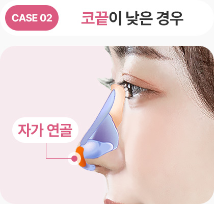 코끝이 낮은경우 자가연골 낮은코성형