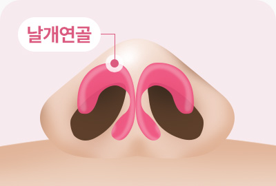 복코 성형 날개연골