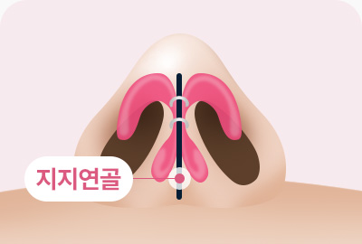 복코 성형 지지연골