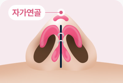 복코 성형 자가연골