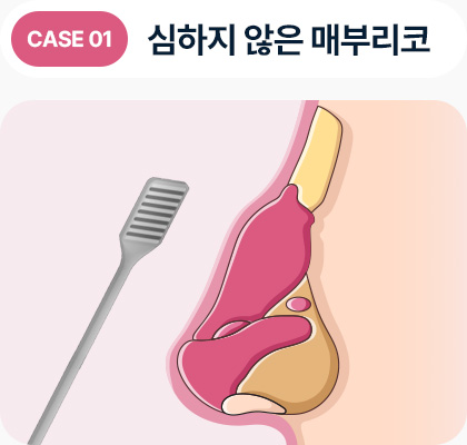 심하지 않은 매부리코
