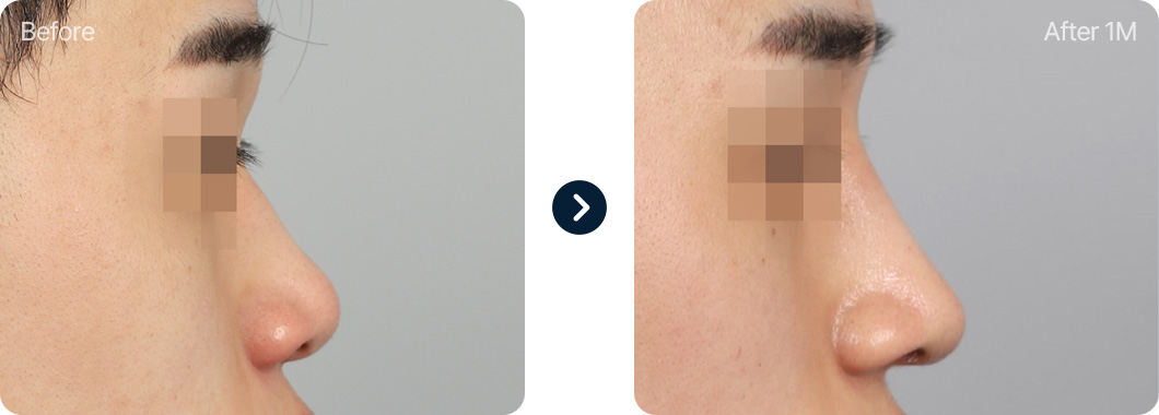 매부리코 성형 전후사진