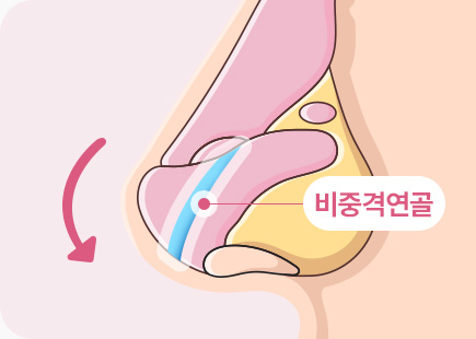 짧은코 들창코 수술 비중격연골