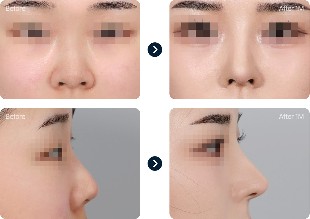 짧은코 들창코 성형 전후사진