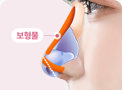 화살코 긴코 수술방법 보형물