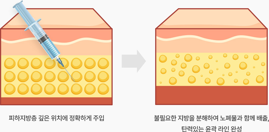 윤곽주사 피하지방층 깊은 위치에 주입 불필요한 지방 분해 노폐물과 함께 배출