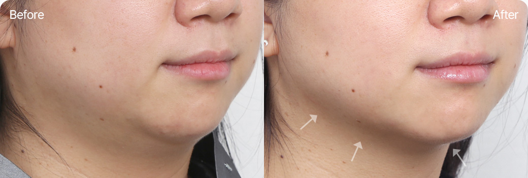 인모드 전후사진 인모드후기 MINI FX FORMA