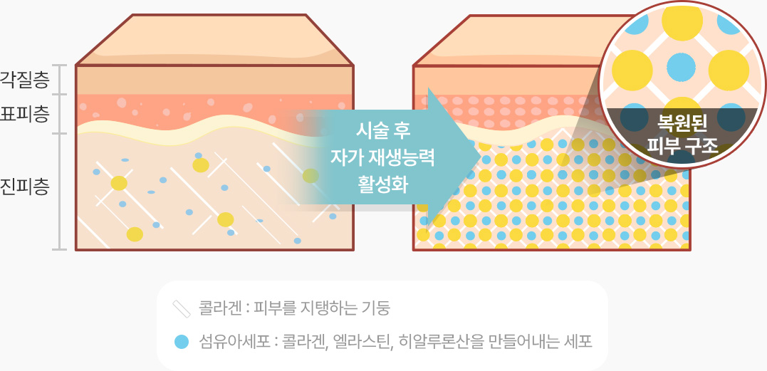 리쥬란 패키지 시술 후 자가 재생능력 활성화 복원된 피부구조