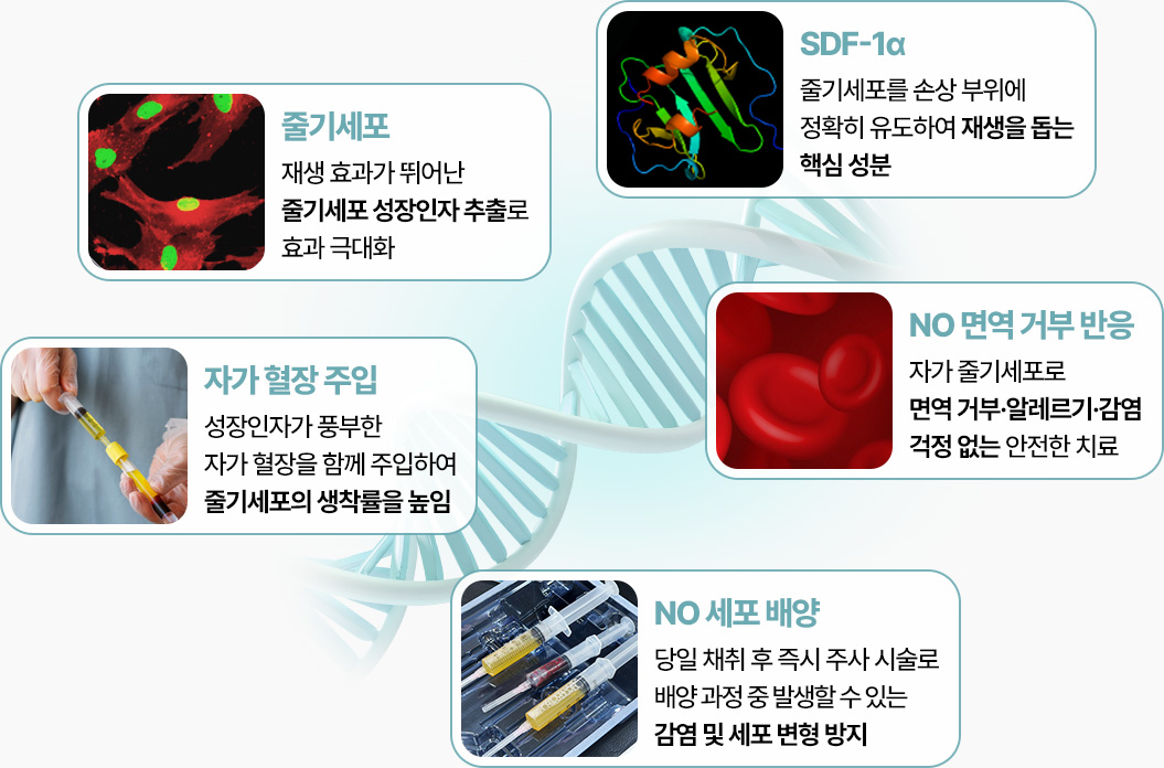 원더풀 줄기세포 주사 줄기세포 SDF-1α 면역거부반응없음 세포배양안함 자가혈장주입