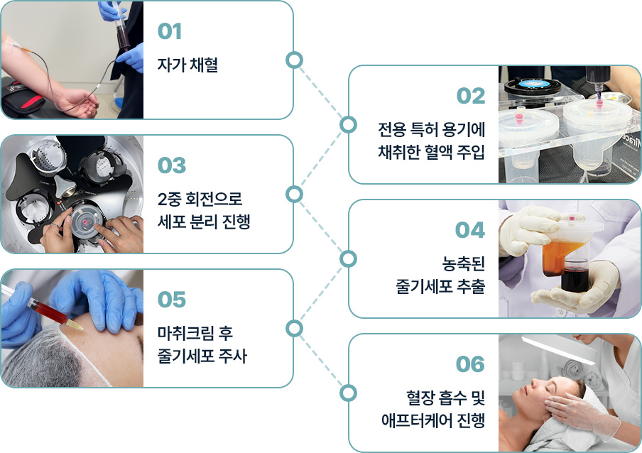원더풀 줄기세포 자가채혈 전용용기에 채취한 혈액주입 2중회전으로 세포분리 농축된 줄기세포 추출 마취크림 후 줄기세포 주사 혈장흡수 및 애프터케어 진행