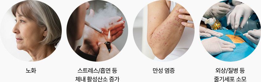 원더풀 줄기세포 감소원인 노화 스트레스 흡연 체내활성산소증가 만성염증 외상 질병등 줄기세포소모