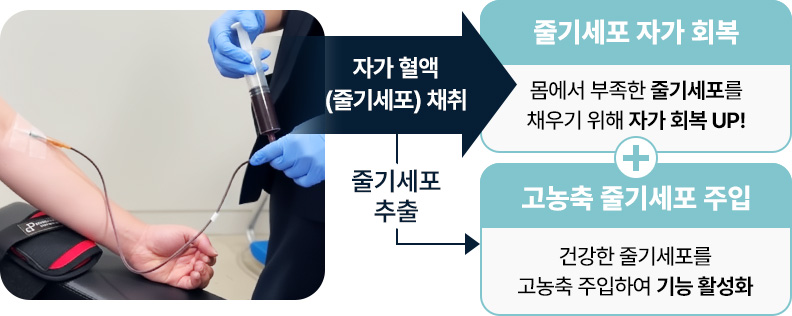 원더풀 줄기세포 자가혈액 채취하면 줄기세포 자가회복 줄기세포 추출하여 고농축 줄기세포 주입